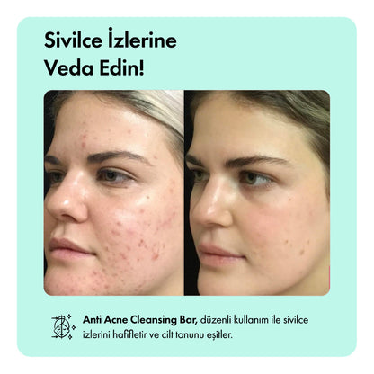 Anti-Acne™ Sivilce Karşıtı Bakım Rutini