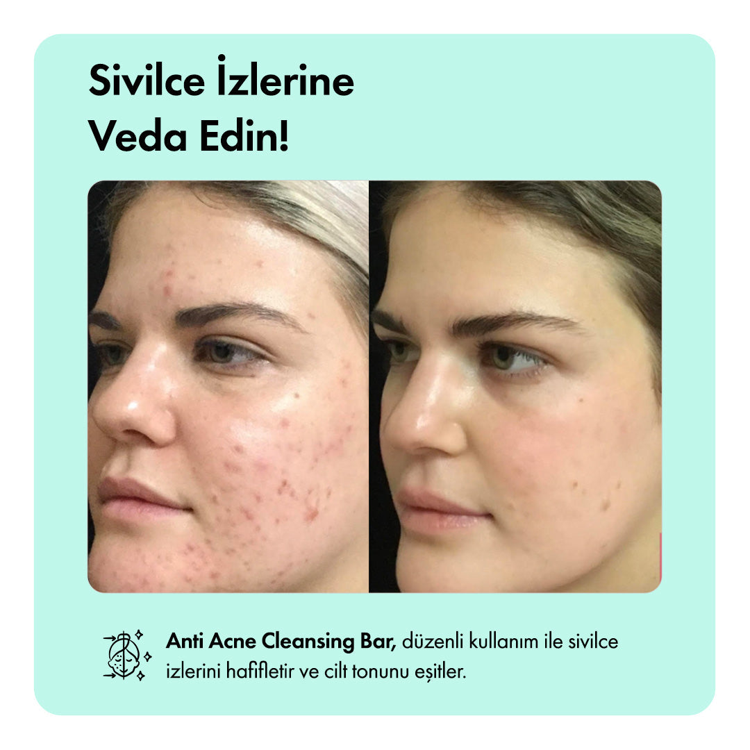 Hediye Anti-Acne Serumu