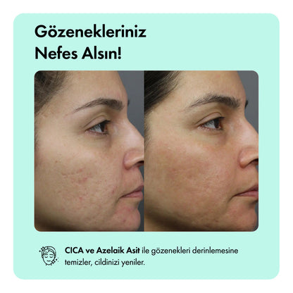 Hediye Anti-Acne Serumu